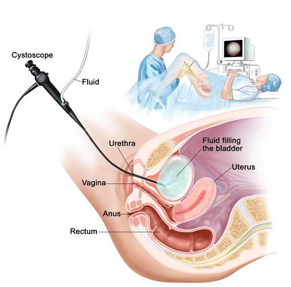 κυστεοσκοπηση