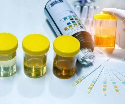 Νιτρώδη στα ούρα