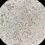 πυοσφαίρια στα ούρα