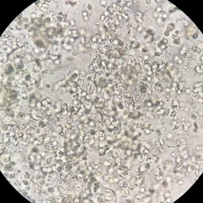 πυοσφαίρια στα ούρα