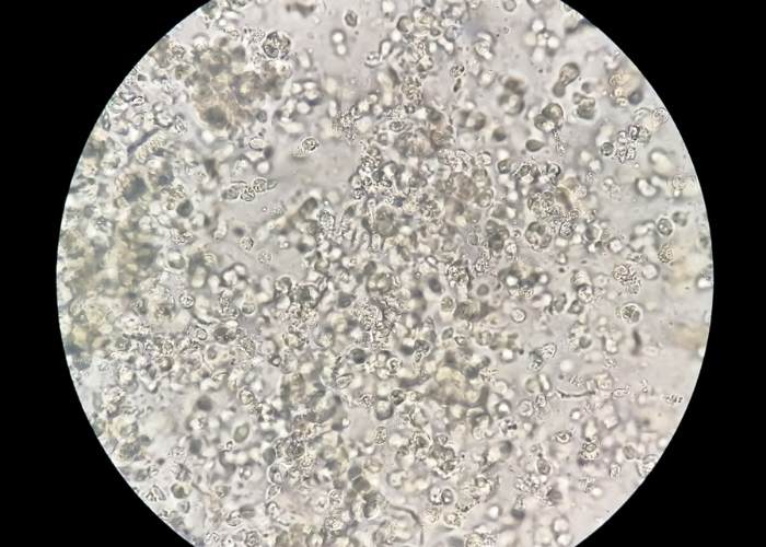 πυοσφαίρια στα ούρα